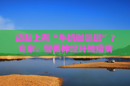 皮肤上有“牛奶咖啡斑”？专家：警惕神经纤维瘤病